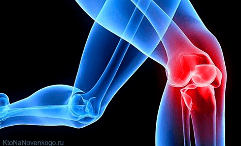 Arthrosis