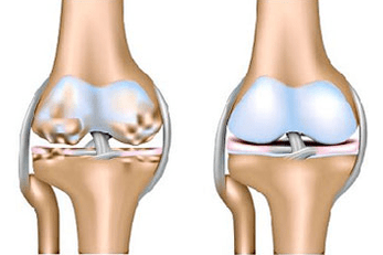 Together and healthy arthrosis