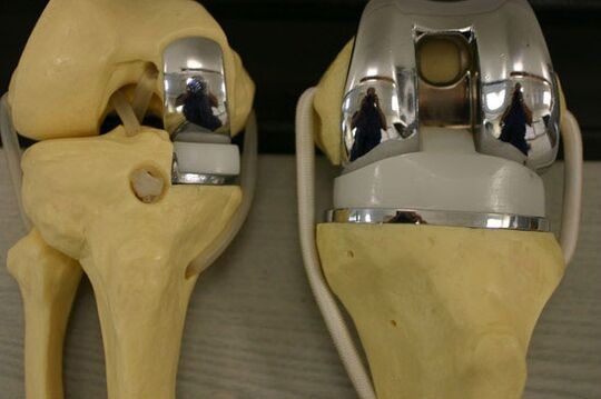 Knee joint endoprosthetics variants
