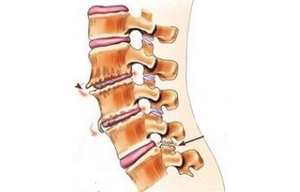 spondylarthrosis as the cause of back pain
