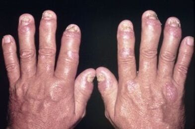 Why finger joints are sick