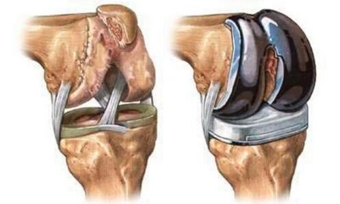 Endoprostetics of the knee joint for arthrosis