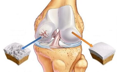Healthy joints and knee joint arthrosis