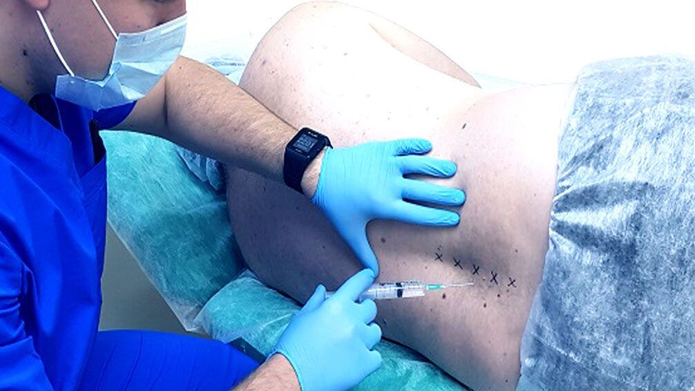 Spinal blocks for osteochondrosis