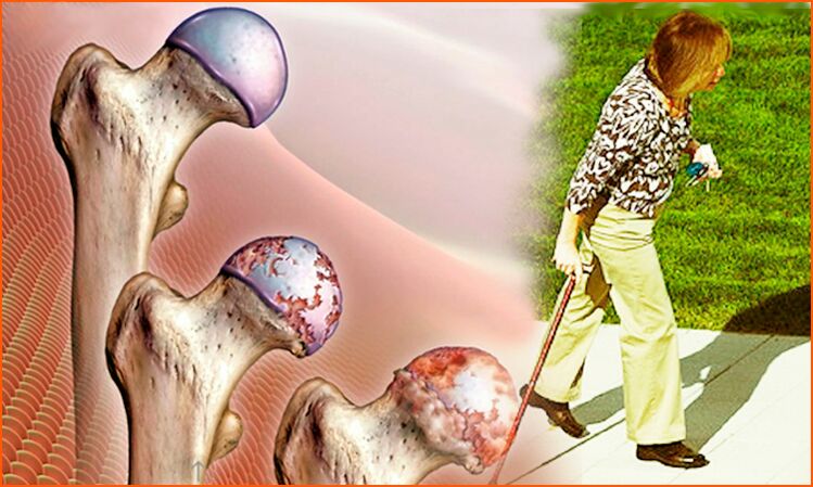Persistent lameness in the last stage of hip joint arthrosis