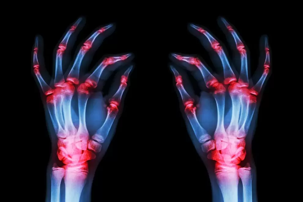 arthrosis of the finger joints