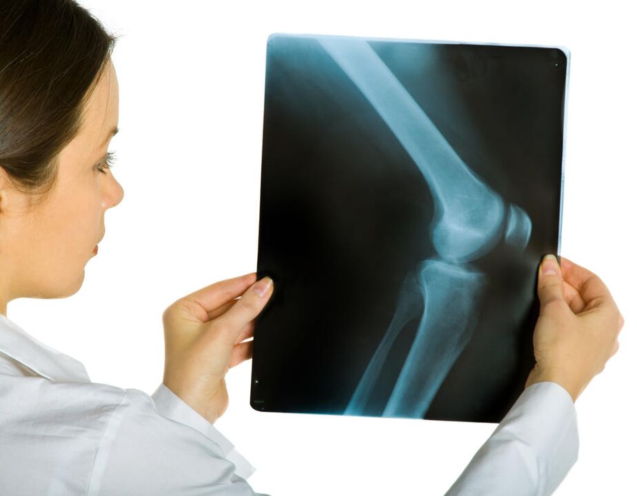 An X-ray of the knee joint will reveal the presence of deforming arthrosis